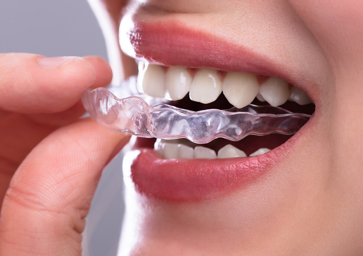 Your Complete Guide to Invisalign in Cairns